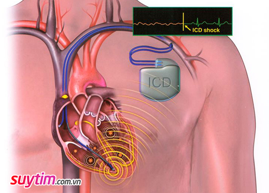 Điều trị rối loạn nhịp tim với máy tạo nhịp từ tế bào cơ tim