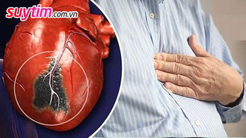 Thiếu máu cơ tim thầm lặng - Nguy hiểm vì không có dấu hiệu cảnh báo