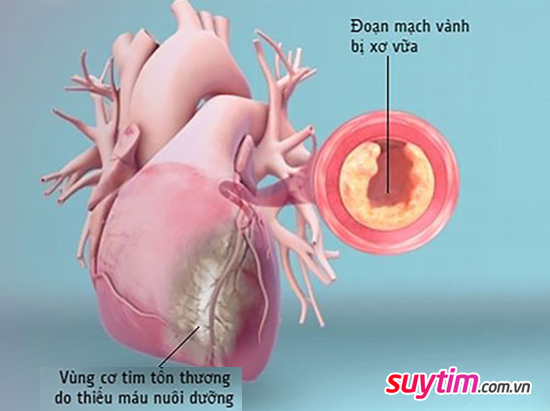 Triệu chứng thiếu máu cơ tim, không phải lúc nào cũng là đau thắt ngực!