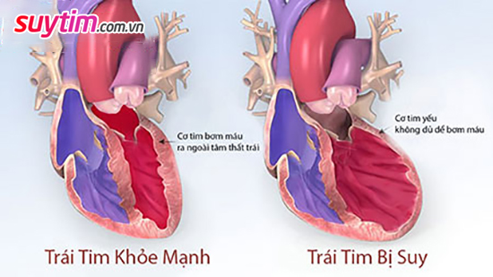 Suy tim - Hậu quả tất yếu của các bệnh tim mạch