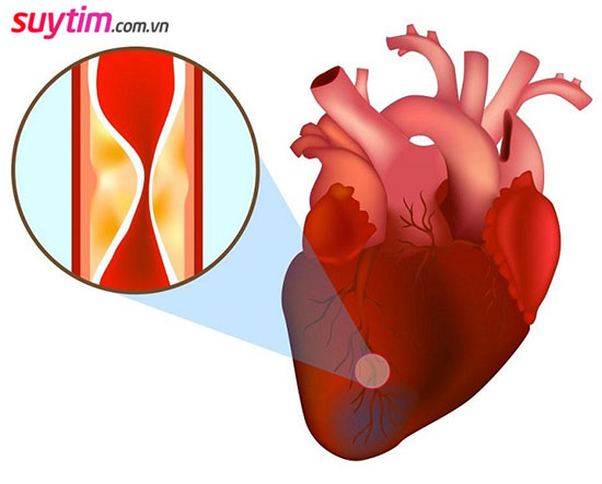Thiếu máu cơ tim có nguy hiểm không? 3 rủi ro bạn cần biết