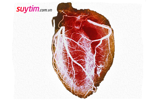 Hiểu thế nào về cơn nhồi máu cơ tim?
