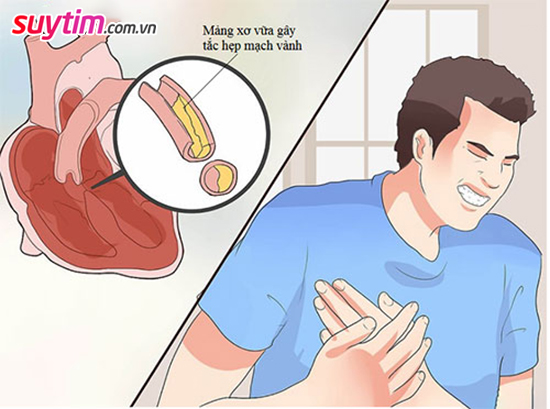 Triệu chứng bệnh mạch vành không phải lúc nào cũng bắt đầu bằng cơn đau thắt ngực
