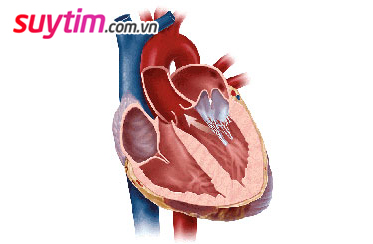 Triệu chứng hở van tim: Nặng, nhẹ tùy vào loại van và mức độ hở