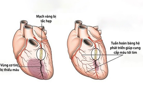 Tuần hoàn bàng hệ mạch vành - Chìa khóa ngăn nhồi máu tim