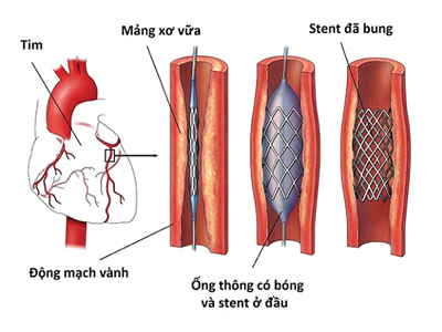 Đặt stent mạch vành: Tất cả những điều người bệnh cần biết