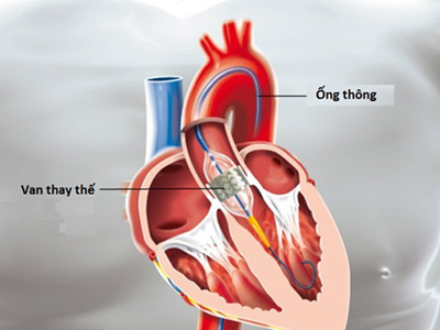 7 nguyên nhân gây hẹp van tim: Biết để điều trị hiệu quả