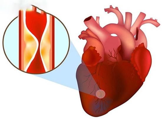Thiếu máu cơ tim có nguy hiểm không? 3 rủi ro bạn cần biết