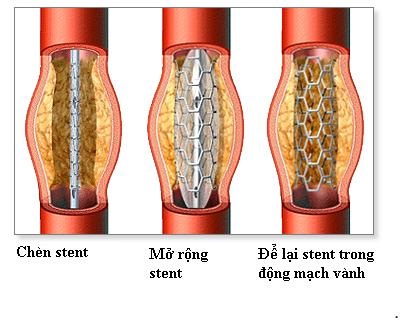 Bệnh động mạch vành và phương pháp đặt Stent