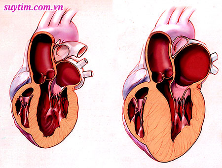 Huyết áp cao lâu dần gây dày thất và dễ dẫn tới suy tim