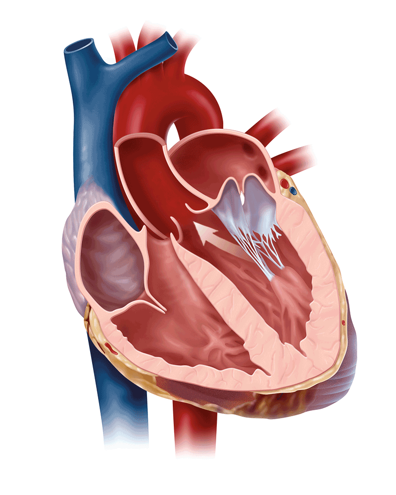 Hở van tim 2 lá làm máu phụt ngược lên buồng tâm nhĩ trái khi tim co bóp