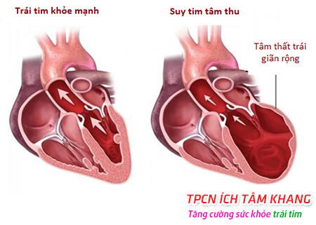 Suy tim tâm thu làm giảm khả năng bơm máu khỏi tim