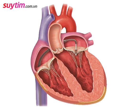 Hở van tim 2 lá: Triệu chứng, sự nguy hiểm và cách điều trị 