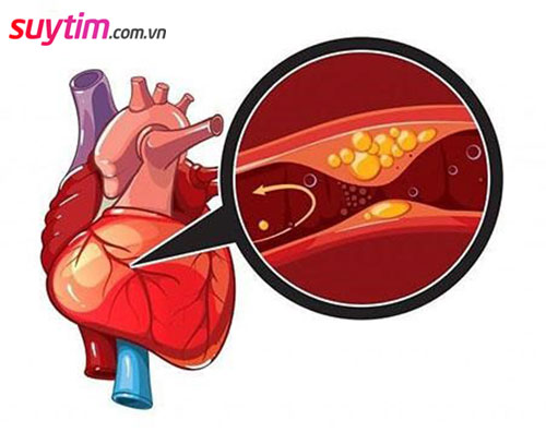 Giảm cholesterol, giảm xơ vữa mạch vành là mục tiêu điều trị thiếu máu cơ tim quan trọng