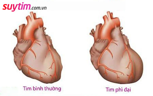 Hẹp van 3 lá làm thay đổi cấu trúc tim dẫn tới tim to