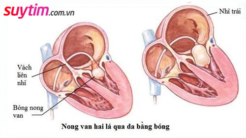 Nong van tim hai lá bằng bóng qua da thường được dùng để điều trị hẹp van tim