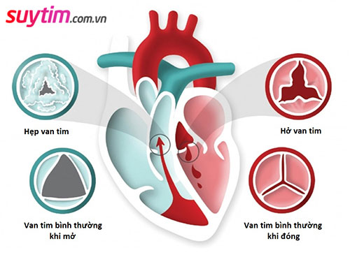 Thay van tim được áp dụng khi van tim bị hẹp hoặc hở nặng.