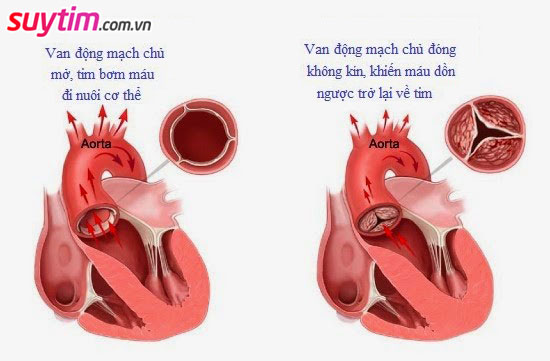 Hở van động mạch chủ tăng nguy cơ suy tim
