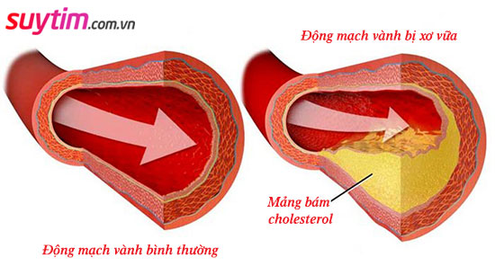 Sự tích tụ của cholesterol gây xơ vữa động mạch vành, dẫn tới thiếu máu cơ tim cục bộ