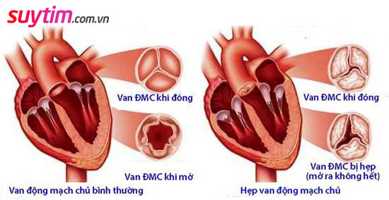 Hình ảnh van tim bị hẹp và van tim bình thường