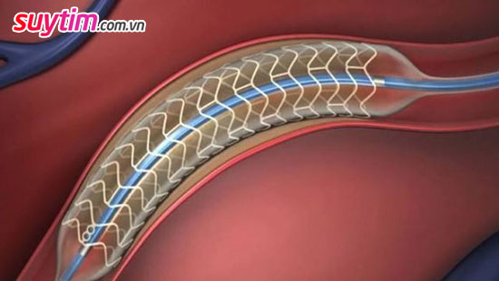 Đặt stent giúp tăng cường máu nuôi tim sẽ cải thiện suy tim do bệnh mạch vành