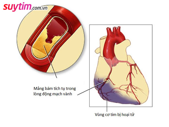 Thiếu máu cơ tim: 10 thông tin cần biết để tránh nhồi máu tim