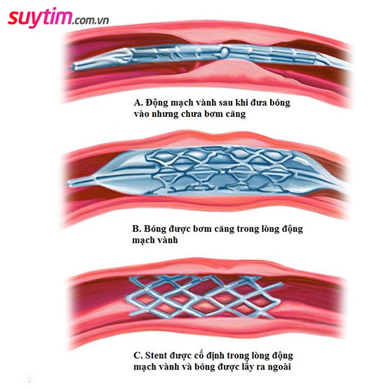 Các loại stent mạch vành, nên đặt stent tự tiêu hay stent phủ thuốc