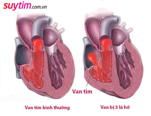 Hở van tim 3 lá 2/4 - Cách ngăn bệnh tiến triển và sống khỏe