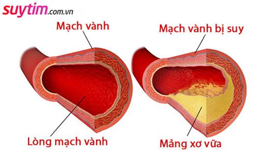 Suy mạch vành chủ yếu là do mảng xơ vữa bám dính vào thành mạch vành