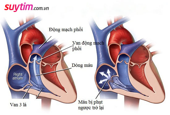 Hở van tim 3 lá làm máu bị phụt ngược trở lại nhĩ phải khi tim co bóp