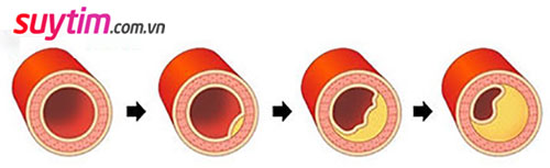 Những người bị tắc hẹp mạch vành có nguy cơ cao gặp phải cơn nhồi máu cơ tim