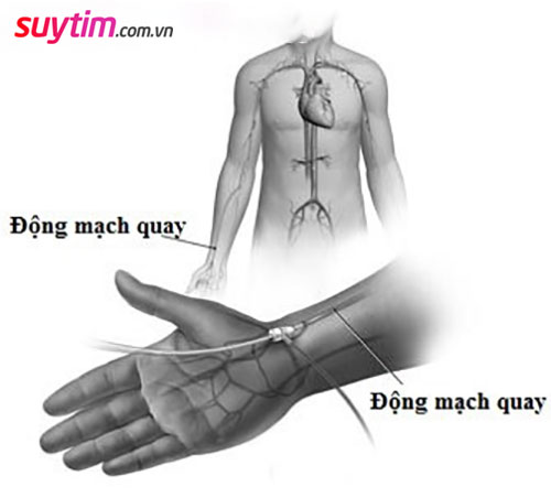Nếu đặt stent mạch vành qua động mạch quay, bạn cần hạn chế cầm vần nặng.