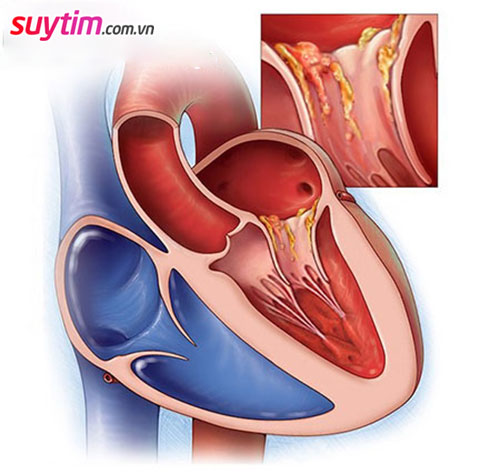 Viêm nội tâm mạc thường xuất hiện ở van 2 lá, van động mạch chủ nhiều hơn là ở van tim 3 lá