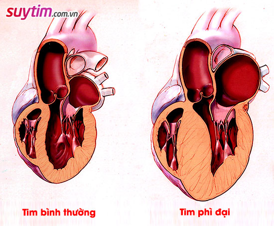 Bóng tim to - Coi chừng suy tim và các biến cố tim mạch nguy hiểm