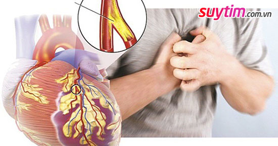 Đau thắt ngực có thể là dấu hiệu của một cơn đau tim nguy hiểm