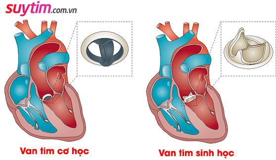 Van tim cơ học có tuổi thọ dài hơn van sinh học
