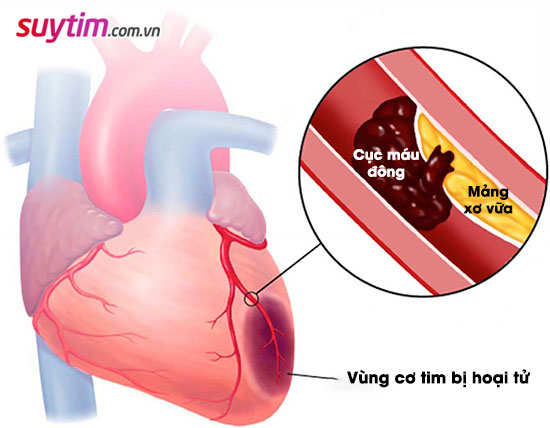 Nhồi máu cơ tim cấp: Nguyên nhân, triệu chứng và cách điều trị