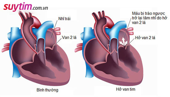 Hở van tim 2/4 là mức độ hở trung bình nhưng có thể tiến triển nặng theo thời gian