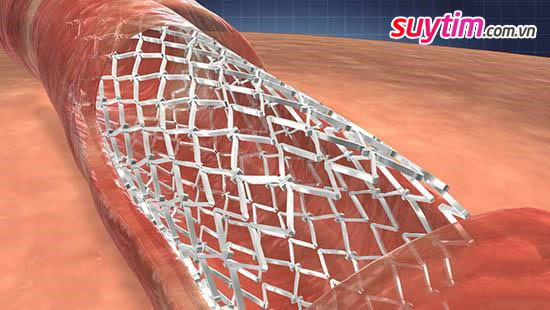 Đặt stent động mạch vành – thủ thuật điều trị quan trọng trong can thiệp tim mạchĐặt stent động mạch vành – thủ thuật điều trị quan trọng trong can thiệp tim mạch