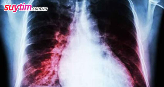 Suy tim toàn bộ gây ứ dịch trong phổi, ho mạn tính, khó thở
