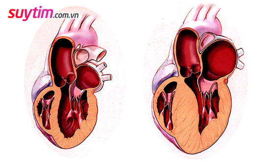 Trong bệnh tim to, thành tim dày lên và buồng tim thu nhỏ lại