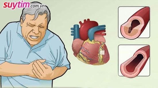 Thiếu máu cơ tim cục bộ: Tất cả những thông tin bạn cần biết