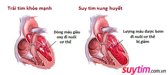 Suy tim sung huyết là gì? Chuyên gia tim mạch giải đáp