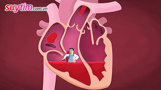 Người bệnh suy tim sống được bao lâu phụ thuộc mức độ tuân thủ chỉ định của bác sĩ