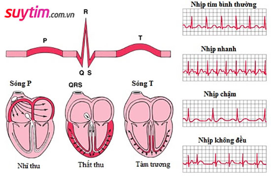 Điện tâm đồ  là xét nghiệm thường dùng trong chẩn đoán suy tim