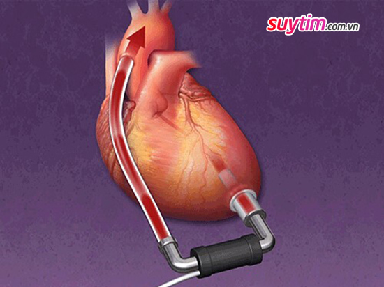   Trong thời gian chờ ghép tim người bệnh suy tim mất bù có thể sẽ được cấy thiết bị trợ tim