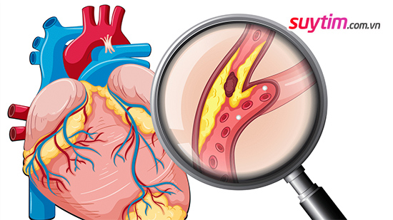 Mảng xơ vữa cứng trong động mạch vành là nguyên nhân gây đau thắt ngực ổn định.