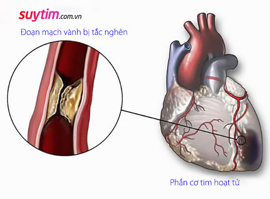 Hội chứng mạch vành cấp tính có thể dẫn đến hoại tử cơ tim