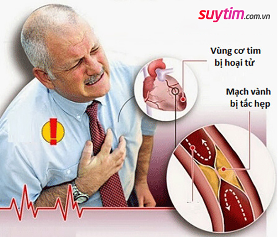 Đau thắt ngực là dấu hiệu điển hình của nhồi máu cơ tim
