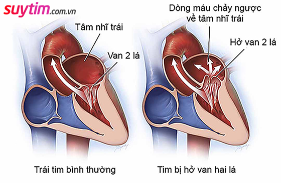 Biến chứng thường gặp nhất của bệnh thấp tim là hở van 2 lá.